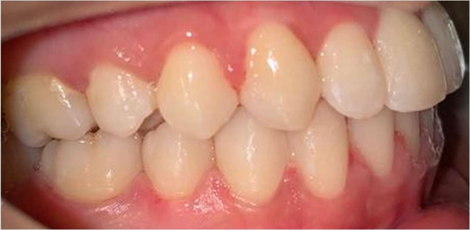 Class 3 Distalization - After